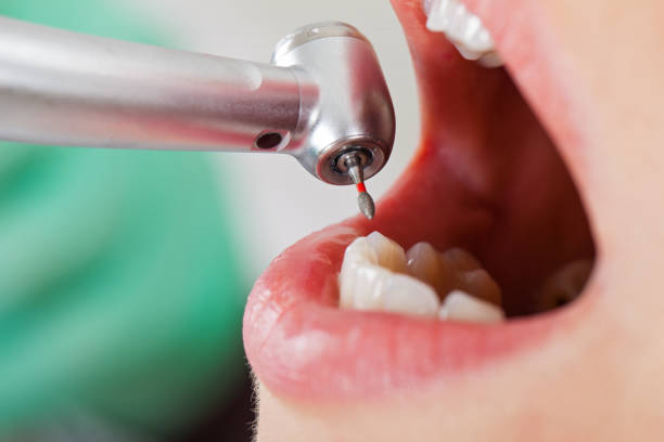 Best Emergency Tooth Extraction in Perry Park, CO